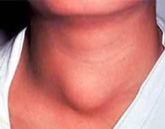 лечение кистозного зоба щитовидной железы