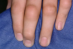 лечение воспаленных суставов пальцев рук